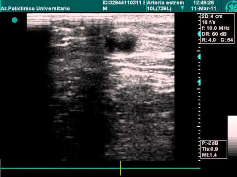 Venenthrombose der unteren Extremitäten bei der Ultraschalluntersuchung