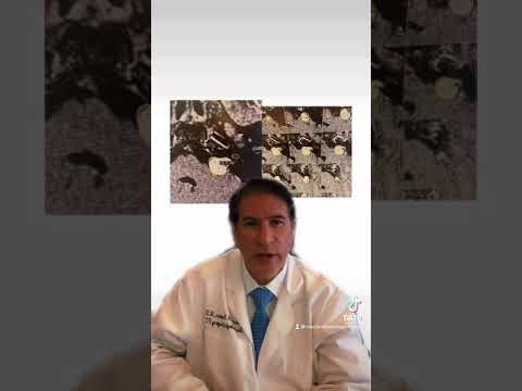 Dr. Michael Brisman Discusses Acoustic Neuroma