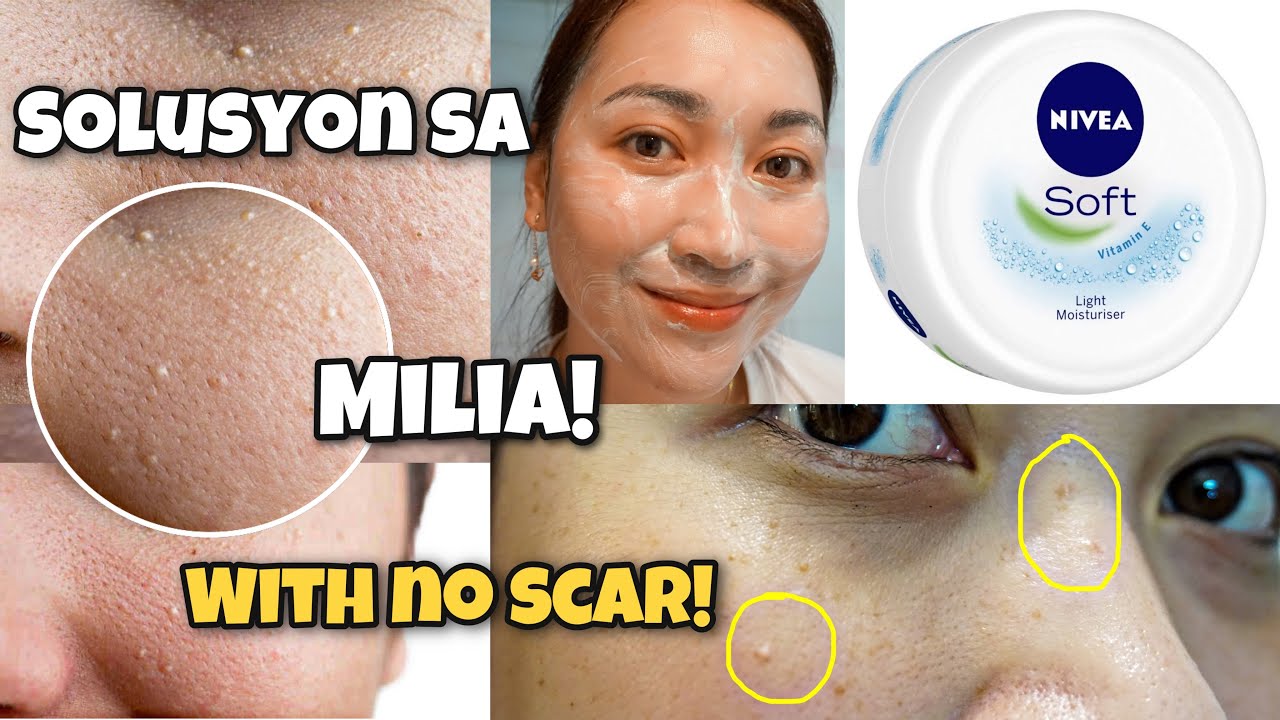 PAANO MAGTANGGAL NG MILIA-BUTLIG AT HOME Safe Easy & Scar Free | FEAT. Nivea Cream | ayaesguerra