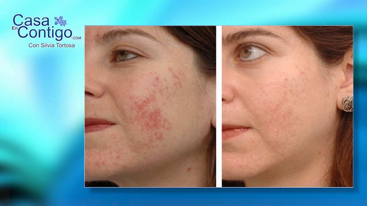 Watch Como quitar las manchas de la piel con Luz pulsada, una solución para las manchas de la piel Now Como quitar las manchas de la piel con Luz pulsada, una solución para las manchas de la piel
