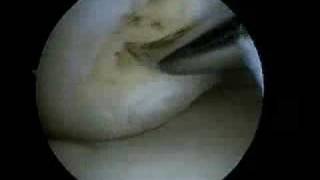 Biologic Joint Replacement: Meniscus