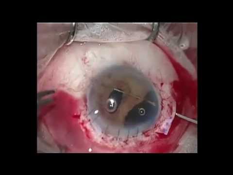 Repair Of Iris Defects