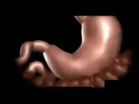 Manga Gástrica /  Dr. Alejandro Santoyo Flores