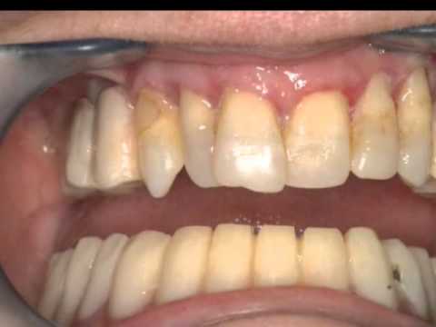 Clínica de Estética dental Láser .Algeciras.Dr Joaquín garcia rodriguez Miniatura de video de YouTube 6