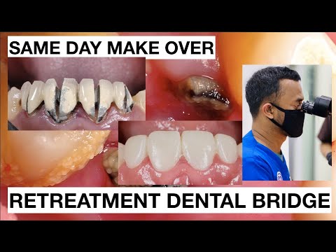 Same Day Smile Make Over Retreatment Dental Bridge