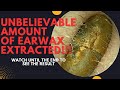 UNBELIEVABLE Amount Of Earwax Extracted From This Ear Watch Until The End
