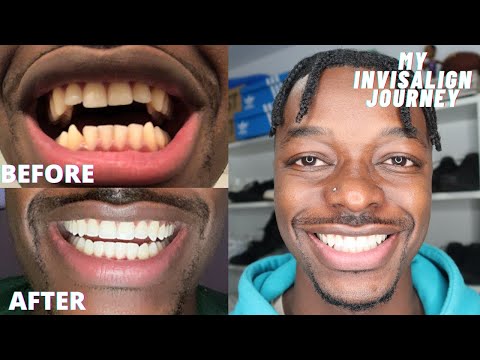 INVISALIGN REVIEW | IS IT WORTH IT? | COST, PAIN, ETC | EVERYTHING YOU NEED TO KNOW | MARLON T.
