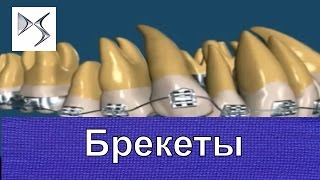 Брекеты Как работают брекеты Ортодонтия Стоматология