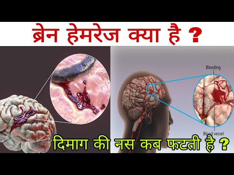 ब्रेन हेमरेज क्या है ? दिमाग की नस क्यों और कैसे फटती है ? Brain hemorrhage in hindi