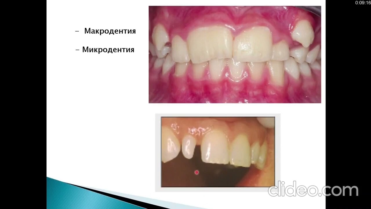 Некариозные поражения твердых тканей зубов