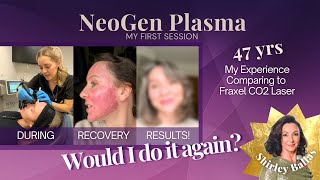 NeoGen Plasma Non-surgical Facelift - My First Session 47yrs – What it’s REALLY Like!