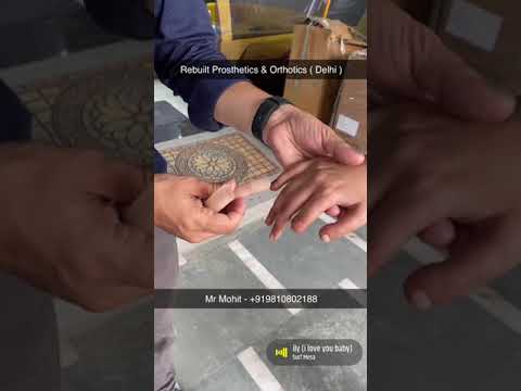 Rebuilt artificial silicone foot, below the elbow