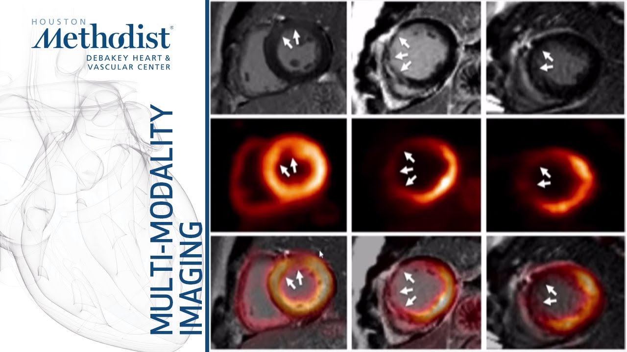 Heart Failure 1: Evaluating Myocardial Viability-Role of MMI (Zoghbi, Al-Mallah, Shah) Jan. 14, 2020