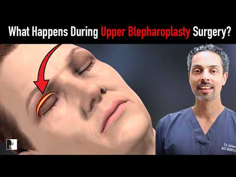 What Really Happens During Upper Blepharoplasty Surgery? - 3D Animation Explanation!