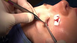 Lower Blepharoplasty with Dr. Paul Nassif