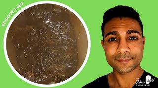 Download the video "1,487 - Totally Blocked Ear Wax Removal"