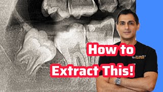 Impacted Wisdom Tooth Extraction 