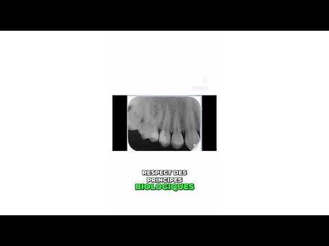 Coiffage pulpaire – Endodontie