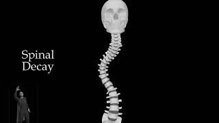 Spinal Decay - Scoliosis - Skull and Spine Rotated