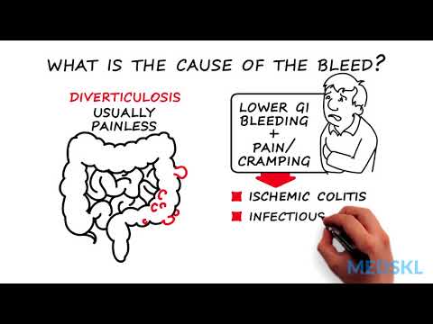 Lower GI Bleeding: The 3 steps to take when you aren't sure of the source