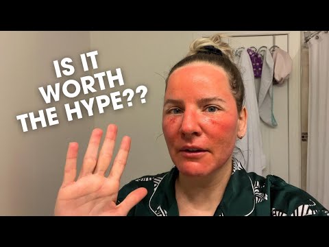 My CO2 Laser Recovery + Aftercare & Results