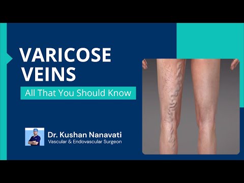Varicose Veins - All that you should know | Dr. Kushan Nanavati | Vascular Surgeon, Vadodara