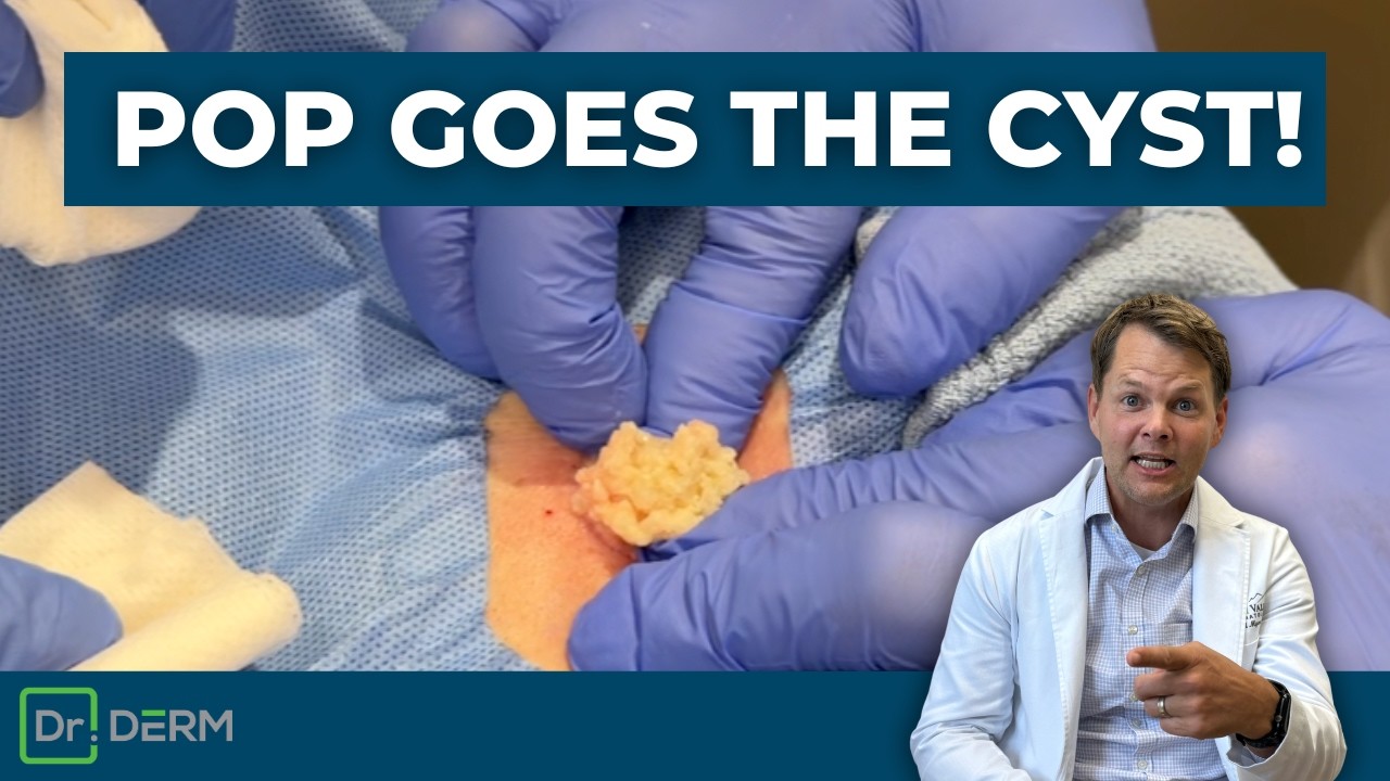 Pop Goes The Cyst! | Dr. Derm