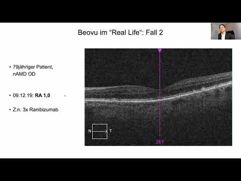 DGII 2021 - 10.13 Lars Olof Hattenbach - Ein Jahr Brolucizumab - Wirksamkeit und Sicherheit...