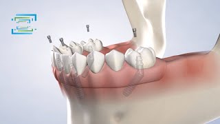 Full-Arch Restoration at Fresno Oral Maxillofacial Surgery & Dental Implant Center