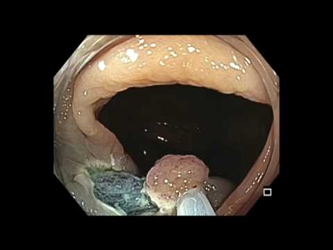 Colonoscopia: resección endoscópica de la mucosa de colon transverso grande