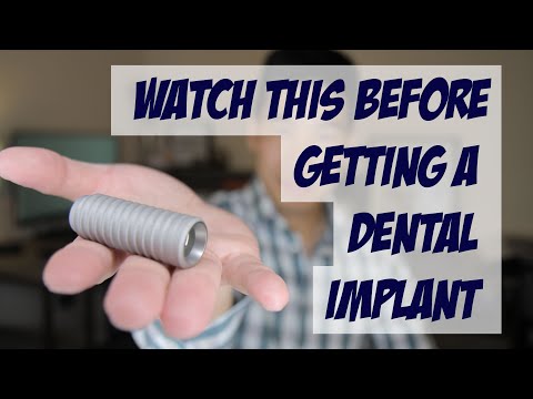 Important things you should know about dental implants - Dental implant facts
