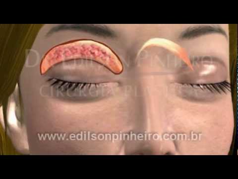 Lozioni da hypostases per occhi Olio per un contorno e un sollevamento di faccia