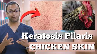 Keratosis Pilaris | Do You Have Rough Patches & Tiny Bumps? | How to Treat Keratosis Pilaris