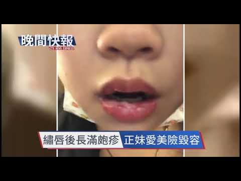 【晚間搶先報】疑免疫力下降 女繡唇誘發皰疹感染!