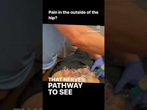Lateral Hip pain cupping and superior cluneal nerve entrapment