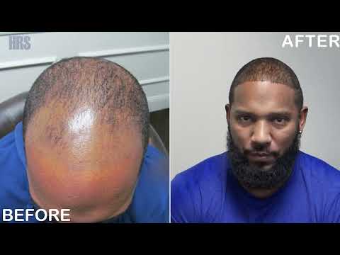 Only Six Months After The FUE Hair Transplant - HRS of...