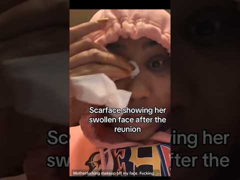 #scarface Face Look #swollen After The #reunion #baddie #chriseanrock #tesehki #chrisean #ohno #no