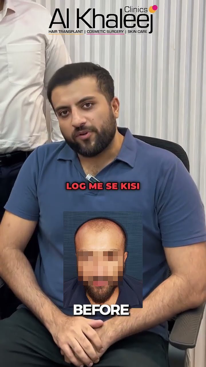 Hair transplant feedback after 6 months real results - AlKhaleej Clinics