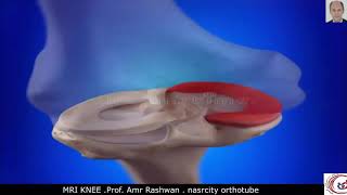 Knee MRI. Prof. Amr Rashwan. nasrcity covid19 time online lectures 2020 image