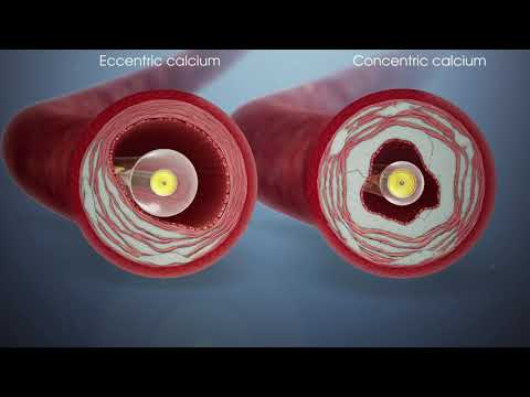 Shockwave IVL in Eccentric vs. Concentric Calcified Lesions