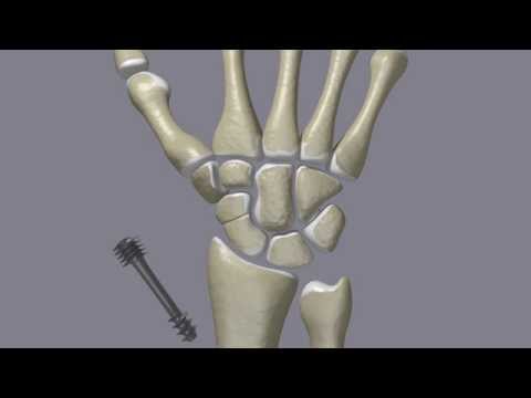 Scaphoid Fractures