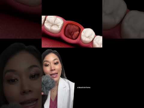 How to avoid dry socket after wisdom tooth extraction. #wisdomtooth #wisdomteeth #drysocket #tooth