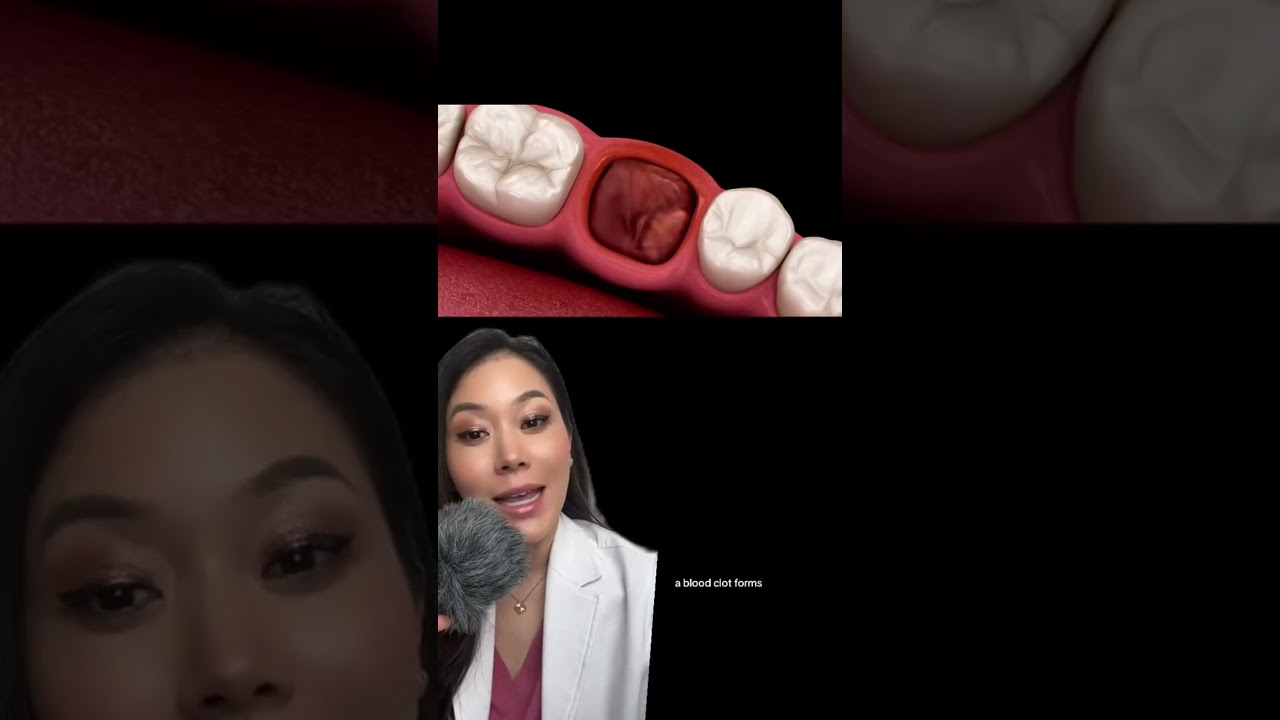 How to avoid dry socket after wisdom tooth extraction. #wisdomtooth #wisdomteeth #drysocket #tooth