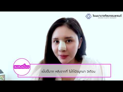การผ่าตัดเต้านม Daria Pynzar หัวนมขยายขนาดหน้าอก