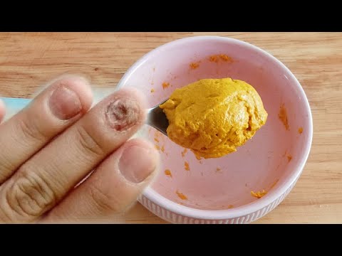 Removes nail fungus without any cream very effectively.  Only 30 minutes