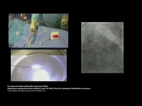How to Modify Calcific Plaque