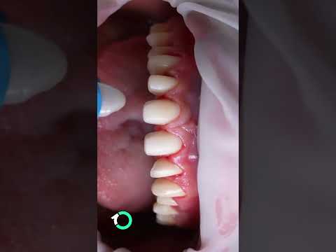 E-Max Lithium Disilicate Porcelain Crowns & Veneers - Surgical Procedure - One Clinic Patient Review Video