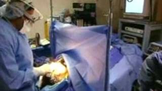 Endoscopic Brow Lift & Eyelid Surgery BNY Wendy