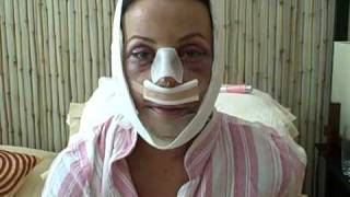 Facial Plastic Surgery: Recovery Day 2