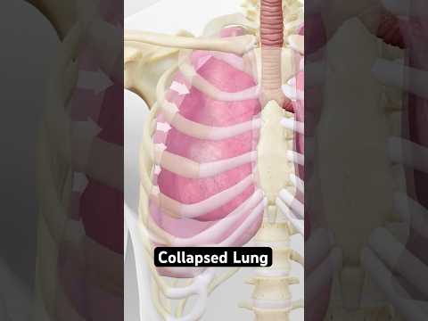 Collapsed lung explained (3D Animation)
